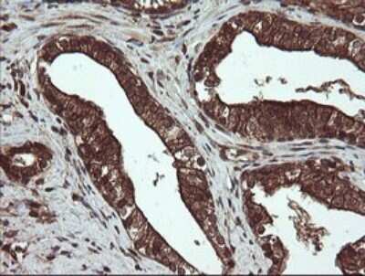 Immunohistochemistry: CXorf26 Antibody (5A11) [NBP2-46410] - Analysis of Carcinoma of Human prostate tissue.