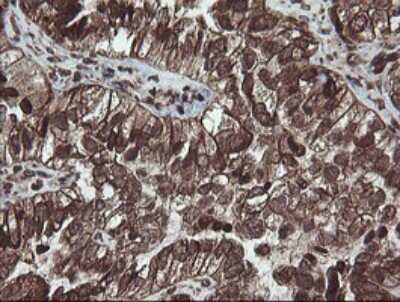 Immunohistochemistry: CXorf26 Antibody (5A11) [NBP2-46410] - Analysis of Adenocarcinoma of Human ovary tissue.