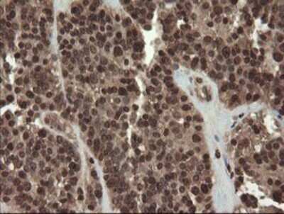 Immunohistochemistry: CXorf26 Antibody (5A11) [NBP2-46410] - Analysis of Carcinoma of Human pancreas tissue.
