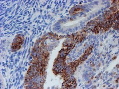 Immunohistochemistry-Paraffin: CYB5R1 Antibody (4B7) [NBP2-01951] - Staining of paraffin-embedded Adenocarcinoma of Human endometrium tissue using anti-CYB5R1 mouse monoclonal antibody.