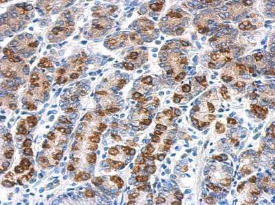 Immunohistochemistry-Paraffin: CYB5R1 Antibody [NBP2-16047] - Immunohistochemical analysis of paraffin-embedded colon ca, using antibody at 1:500 dilution.