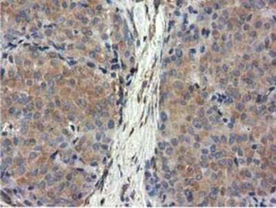 Immunohistochemistry: CYB5R3 Antibody (OTI2A10) - Azide and BSA Free [NBP2-70572] - Staining of paraffin-embedded Adenocarcinoma of Human breast tissue using anti-CYB5R3 mouse monoclonal antibody.