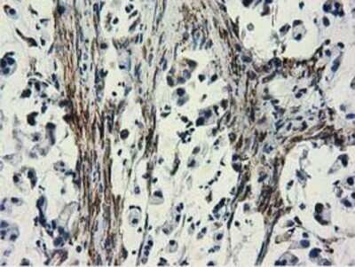 Immunohistochemistry: CYB5R3 Antibody (OTI2A10) - Azide and BSA Free [NBP2-70572] - Staining of paraffin-embedded Adenocarcinoma of Human colon tissue using anti-CYB5R3 mouse monoclonal antibody.