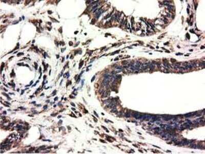 Immunohistochemistry: CYB5R3 Antibody (OTI2A10) - Azide and BSA Free [NBP2-70572] - Staining of paraffin-embedded Adenocarcinoma of Human endometrium tissue using anti-CYB5R3 mouse monoclonal antibody.