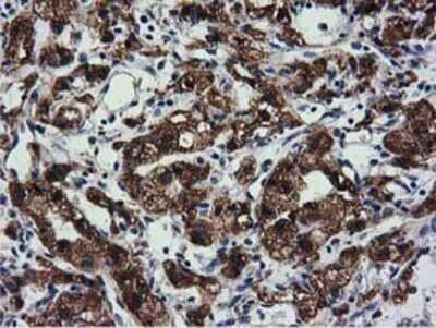 Immunohistochemistry: CYB5R3 Antibody (OTI2A10) - Azide and BSA Free [NBP2-70572] - Staining of paraffin-embedded Carcinoma of Human kidney tissue using anti-CYB5R3 mouse monoclonal antibody.