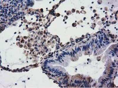 Immunohistochemistry: CYB5R3 Antibody (OTI2A10) - Azide and BSA Free [NBP2-70572] - Staining of paraffin-embedded Carcinoma of Human lung tissue using anti-CYB5R3 mouse monoclonal antibody.