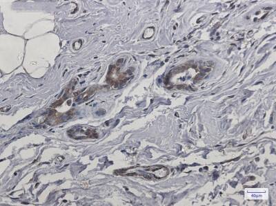 Immunohistochemistry-Paraffin: CYB5R3 Antibody (S01-9F3) [NBP3-19614] - Immunohistochemistry of CYB5R3 in paraffin-embedded Human breast cancer tissue using NBP3-19614 at dilution 1/50