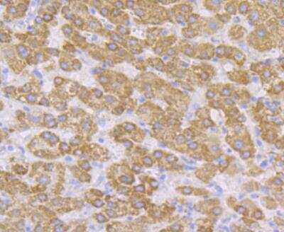 Immunohistochemistry: CYP27A1 Antibody (JG40-36) [NBP2-76827] - Immunohistochemical analysis of paraffin-embedded human liver cancer tissue using anti-CYP27A1 antibody. Counter stained with hematoxylin.