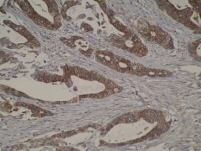 Immunohistochemistry: CYP51A1 Antibody (N6-P2H5-G8) [NBP2-50216] - Photomicrograph of primary tumour.