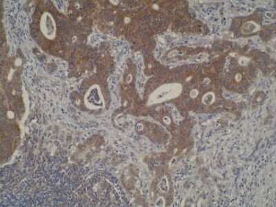 Immunohistochemistry: CYP51A1 Antibody (N6-P2H5/G8) [NBP2-50216] - Photomicrograph of metastatic tissue IHC using N6-P2H5*G8