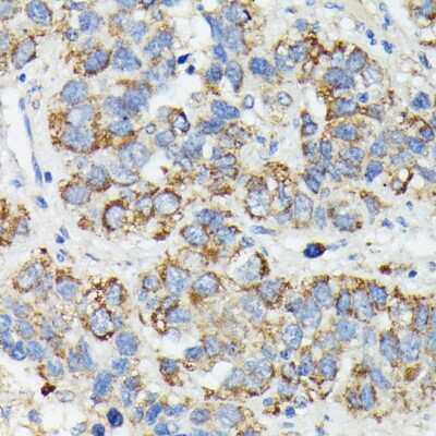 Immunohistochemistry-Paraffin: CYTB Antibody [NBP2-92639] - Human liver cancer using MT-CYB antibody at dilution of 1:100 (40x lens).