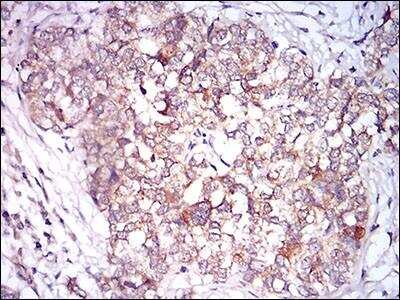 Immunohistochemistry-Paraffin: CaM Kinase II gamma Antibody (8G10C1) [NBP2-37262] - Immunohistochemical analysis of paraffin-embedded bladder cancer tissues using CAMK2G mouse mAb with DAB staining.