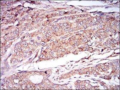 Immunohistochemistry-Paraffin: CaM Kinase II gamma Antibody (8G10C1) [NBP2-37262] - Immunohistochemical analysis of paraffin-embedded prostate cancer tissues using CAMK2G mouse mAb with DAB staining.