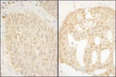 Immunohistochemistry: CaMKK alpha Antibody [NBP1-42682] - Sample: FFPE section of human lung carcinoma (left) and human prostate carcinoma (right). Antibody: Affinity purified rabbit anti- CaMKK alpha used at a dilution of 1:1,000 (1ug/ml). Detection: DAB