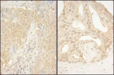 <b>Independent Antibodies Validation and Biological Strategies Validation.</b>Immunohistochemistry-Paraffin: CaMKK alpha Antibody [NBP1-42683] - Section of human lung carcinoma (left) and human prostate carcinoma (right). Antibody: Affinity purified rabbit anti- CaMKK alpha used at a dilution of 1:200 (1ug/ml). Detection: DAB