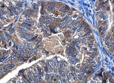<b>Genetic Strategies Validation. </b>Immunohistochemistry-Paraffin: CaMKK2 Antibody [NBP1-31247] - Paraffin-embedded human endometrial cancer  CaMKK beta antibody diluted at 1:500.