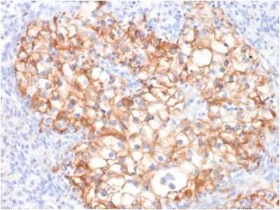 Immunohistochemistry-Paraffin: Cadherin-16 Antibody (CDH16/2125) - Azide and BSA Free [NBP2-79856] - Formalin-fixed, paraffin-embedded human Renal Cell Carcinoma stained with Cadherin-16 Antibody (CDH16/2125).