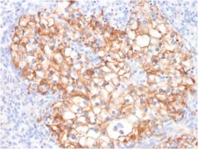 Immunohistochemistry-Paraffin: Cadherin-16 Antibody (CDH16/2125) - Azide and BSA Free [NBP2-79856] - Formalin-fixed, paraffin-embedded human Renal Cell Carcinoma stained with Cadherin-16-Monospecific Mouse Monoclonal Antibody (Cadherin-16/2125).