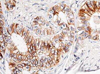 Immunohistochemistry-Paraffin: Cadherin-17 Antibody (029) [NBP2-89891] -  Staining of human CDH17 in human rectal carcinoma with rabbit monoclonal antibody (1:200, formalin-fixed paraffin embedded sections). Positive staining was localized to intestinal gland.