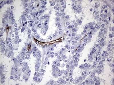 Immunohistochemistry: Cadherin-4/R-Cadherin Antibody (OTI4F5) - Azide and BSA Free [NBP2-70384] - Analysis of Adenocarcinoma of Human ovary tissue. (Heat-induced epitope retrieval by 1 mM EDTA in 10mM Tris, pH8.5, 120C for 3min)