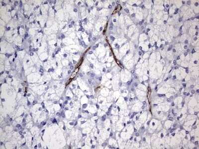 Immunohistochemistry: Cadherin-4/R-Cadherin Antibody (OTI4F5) - Azide and BSA Free [NBP2-70384] - Analysis of Carcinoma of Human thyroid tissue. (Heat-induced epitope retrieval by 1 mM EDTA in 10mM Tris, pH8.5, 120C for 3min)