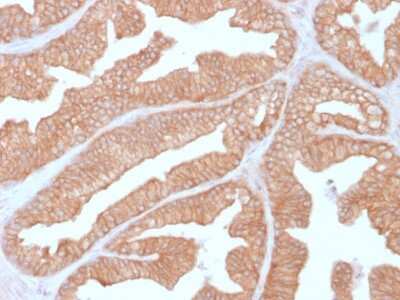 Immunohistochemistry-Paraffin: Calcineurin A Antibody (CALNA/2353) - Azide and BSA Free [NBP3-08395] - Formalin-fixed, paraffin-embedded human Prostate Carcinoma stained with Calcineurin A Mouse Monoclonal Antibody (CALNA/2353).