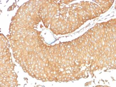 Immunohistochemistry-Paraffin: Calcineurin A Antibody (CALNA/2353) - Azide and BSA Free [NBP3-08395] - Formalin-fixed, paraffin-embedded human Ovarian Carcinoma stained with Calcineurin A Mouse Monoclonal Antibody (CALNA/2353).