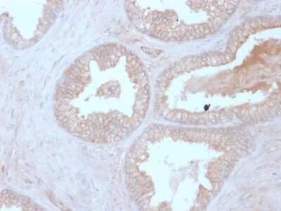 Immunohistochemistry-Paraffin: Calcineurin B Antibody (CALNB/2342) - Azide and BSA Free [NBP3-08464] - Formalin-fixed, paraffin-embedded human Prostate Carcinoma stained with Calcineurin B Mouse Monoclonal Antibody (CALNB/2342).