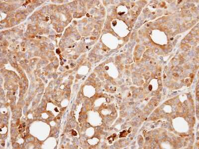 Immunohistochemistry-Paraffin: Calcineurin B Antibody [NBP1-32720] - Paraffin-embedded NCI-N87 xenograft, using antibody at 1:500 dilution.