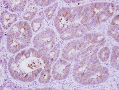 Immunohistochemistry-Paraffin: Calcineurin B Antibody [NBP2-15664] - Analysis of paraffin-embedded Colon ca, using antibody at 1:250 dilution.