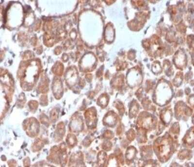 Immunohistochemistry-Paraffin: Calcitonin Antibody (CALCA/3310) [NBP3-13800] - Formalin-fixed, paraffin-embedded human thyroid stained with Calcitonin antibody (CALCA/3310). HIER: Tris/EDTA, pH9.0, 45min. HRP-polymer, 30min. DAB, 5min.