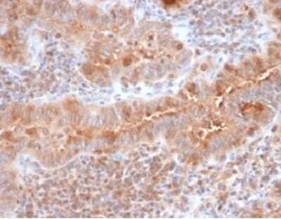 Immunohistochemistry-Paraffin: Calcitonin Antibody (CALCA/3310) [NBP3-13800] - Formalin-fixed, paraffin-embedded human thyroid stained with Calcitonin antibody (CALCA/3310). HIER: Tris/EDTA, pH9.0, 45min. HRP-polymer, 30min. DAB, 5min.