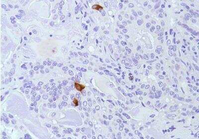 Immunohistochemistry-Paraffin: Calcitonin Antibody (SP17) [NBP2-26483] - Human Lung Adenocarcinoma.