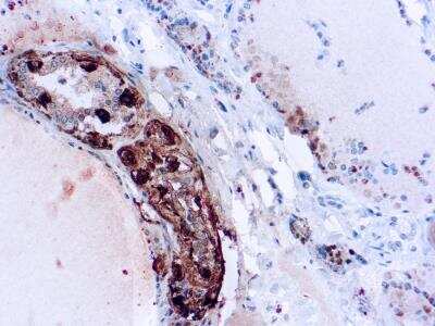 Immunohistochemistry-Paraffin: Calcitonin Antibody (SP17) [NBP2-26483] - Formalin fixed paraffin embedded human thyroid medullary carcinoma stained with Calcitonin antibody (NBP2-26483).