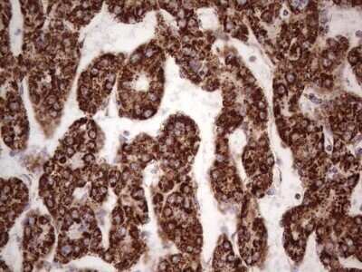 Immunohistochemistry: Calcium Activated Nucleotidase 1/CANT1 Antibody (OTI7F8) - Azide and BSA Free [NBP2-72378] - Analysis of Carcinoma of Human liver tissue.(Heat-induced epitope retrieval by 1 mM EDTA in 10mM Tris, pH8.5, 120C for 3min)