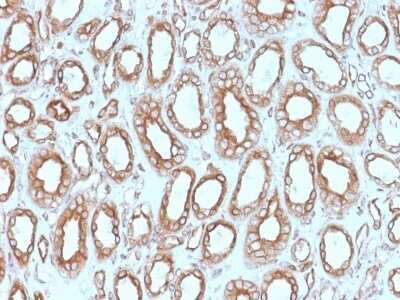 Immunohistochemistry-Paraffin: Calnexin Antibody (CANX/1543) - Azide and BSA Free [NBP2-79835] - Formalin-fixed, paraffin-embedded human Renal Cell Carcinoma stained with Calnexin Antibody (CANX/1543).