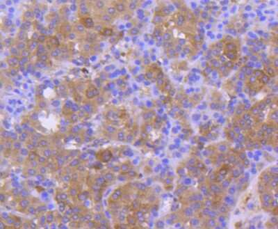 Immunohistochemistry-Paraffin: Calnexin Antibody (SN20-54) [NBP2-67721] - Analysis of paraffin-embedded human liver cancer tissue using anti-Calnexin antibody. Counter stained with hematoxylin.