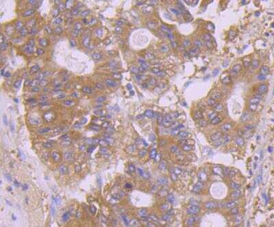 Immunohistochemistry: Calpain 1 Antibody (2A1) [NBP2-76952] - Immunohistochemical analysis of paraffin-embedded human colon cancer tissue using anti-Calpain 1 antibody. Counter stained with hematoxylin.