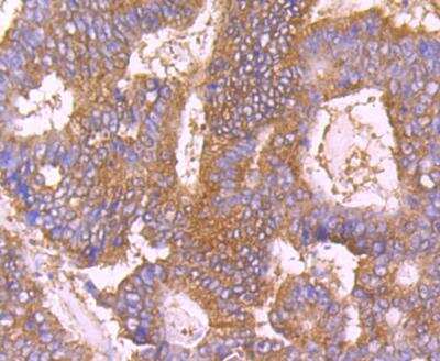Immunohistochemistry: Calpain 1 Antibody (2A2) [NBP2-76963] - Immunohistochemical analysis of paraffin-embedded human colon cancer tissue using anti-Calpain 1 antibody. Counter stained with hematoxylin.