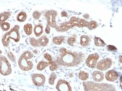 Immunohistochemistry-Paraffin: Calpain 1 Antibody (CAPN1/1530) - Azide and BSA Free [NBP3-08456] - Formalin-fixed, paraffin-embedded human Breast Carcinoma stained with Calpain 1 Mouse Monoclonal Antibody (CAPN1/1530).