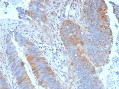 Immunohistochemistry-Paraffin: Calpain 1 Antibody (CAPN1/1530) [NBP3-07387] - Formalin-fixed, paraffin-embedded human Colon Carcinoma stained with Calpain 1 Mouse Monoclonal Antibody (CAPN1/1530).