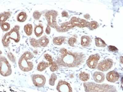 Immunohistochemistry-Paraffin: Calpain 1 Antibody (CAPN1/1530) [NBP3-07387] - Formalin-fixed, paraffin-embedded human Breast Carcinoma stained with Calpain 1 Mouse Monoclonal Antibody (CAPN1/1530).