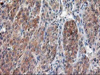 Immunohistochemistry-Paraffin: Calpain 9 Antibody (3G10) [NBP2-01305] - Staining of paraffin-embedded Carcinoma of Human liver tissue using anti-Calpain 9 mouse monoclonal antibody.