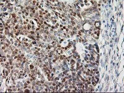 Immunohistochemistry: Calpain 9 Antibody (OTI3G10) - Azide and BSA Free [NBP2-71626] - Staining of paraffin-embedded Adenocarcinoma of Human ovary tissue using anti-Calpain 9 mouse monoclonal antibody.
