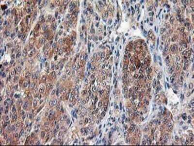 Immunohistochemistry: Calpain 9 Antibody (OTI3G10) - Azide and BSA Free [NBP2-71626] - Staining of paraffin-embedded Carcinoma of Human liver tissue using anti-Calpain 9 mouse monoclonal antibody.