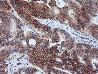 Immunohistochemistry-Paraffin: Calpastatin Antibody (1E7) [NBP2-01819] - Staining of paraffin-embedded Carcinoma of Human pancreas tissue using anti-Calpastatin mouse monoclonal antibody.