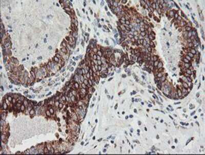 Immunohistochemistry-Paraffin: Calpastatin Antibody (1E7) [NBP2-01819] - Staining of paraffin-embedded Carcinoma of Human prostate tissue using anti-Calpastatin mouse monoclonal antibody.