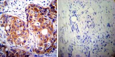 Immunohistochemistry-Paraffin: Calpastatin Antibody (1F7E3D10) [NB120-5582] - Both normal and cancer biopsies of deparaffinized Human breast carcinoma tissues.