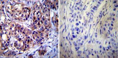 Immunohistochemistry-Paraffin: Calpastatin Antibody (2G11D6) [NB120-3515] - Cancer biopsies of deparaffinized Human breast carcinoma tissue.