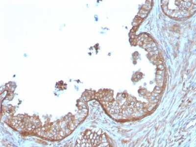 Immunohistochemistry-Paraffin: Calpastatin Antibody (CAST/1550) - Azide and BSA Free [NBP3-08510] - Formalin-fixed, paraffin-embedded human Prostate Carcinoma stained with Calpastatin Mouse Monoclonal Antibody (CAST/1550).